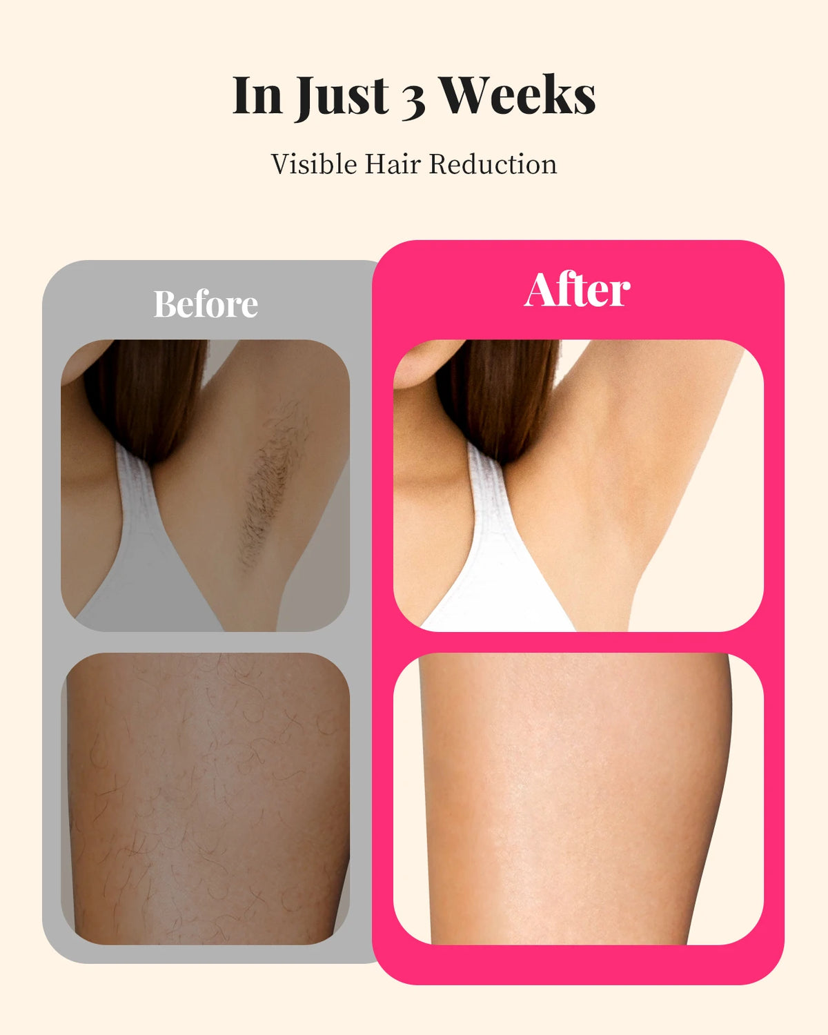Totmizby Portable IPL Hair Removal Device For Face And Body